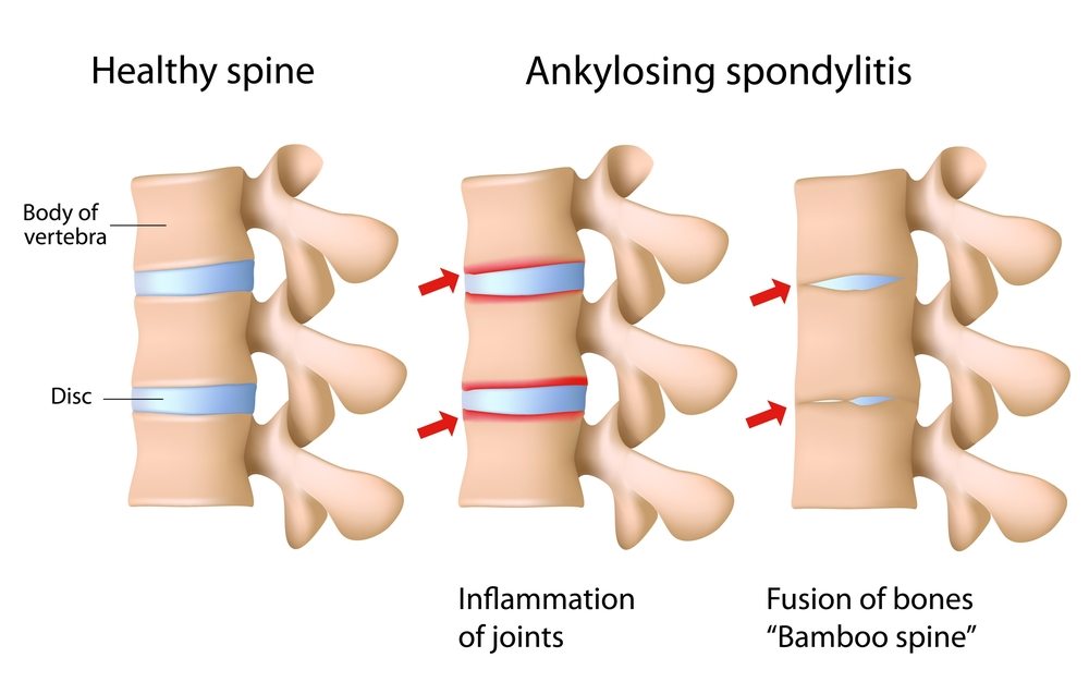 tirzepatide ankylosing spondylitis Ankylosing Spondylitis - Neurosurgical and Spine Consultants, PAFort Worth  Neurosurgeon