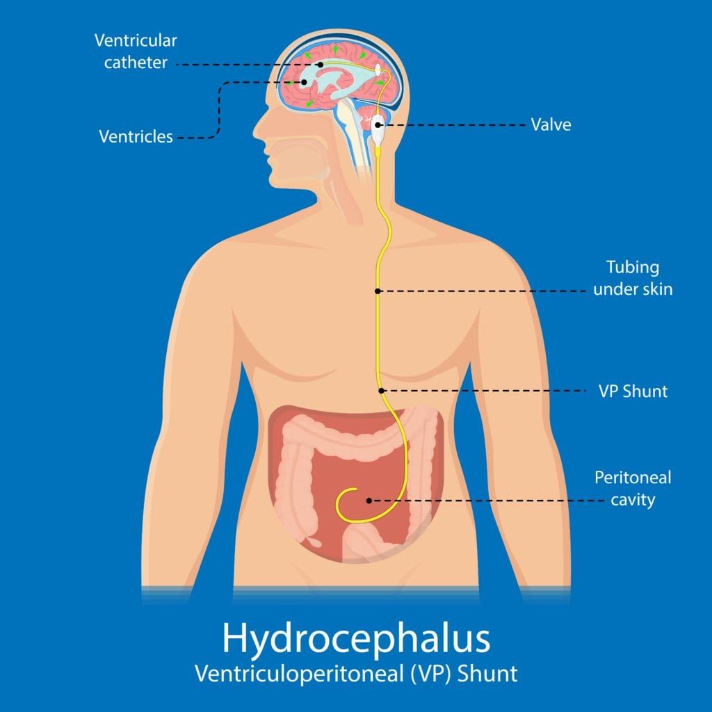 how-does-a-vp-ventriculoperitoneal-shunt-work-fort-worth