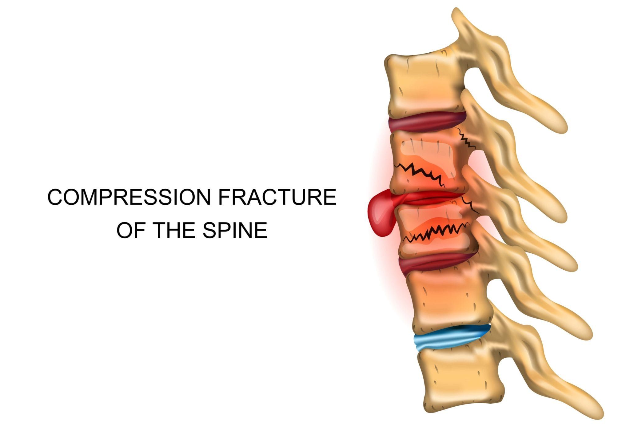 How To Prevent Compression Fractures Fort Worth Neurosurgeon Dr Diana Wilson